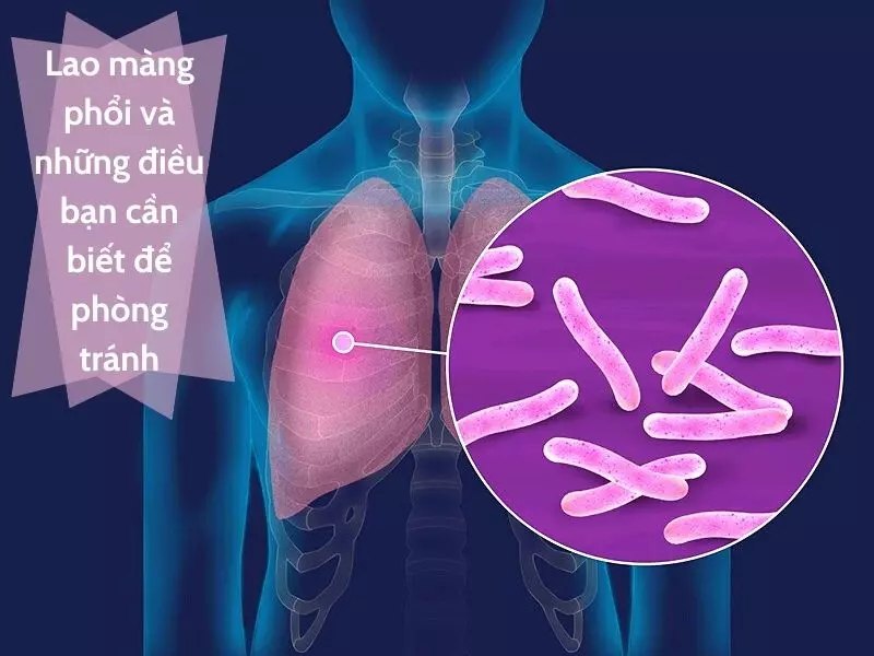 Lao màng phổi và những điều bạn cần biết để phòng tránh
